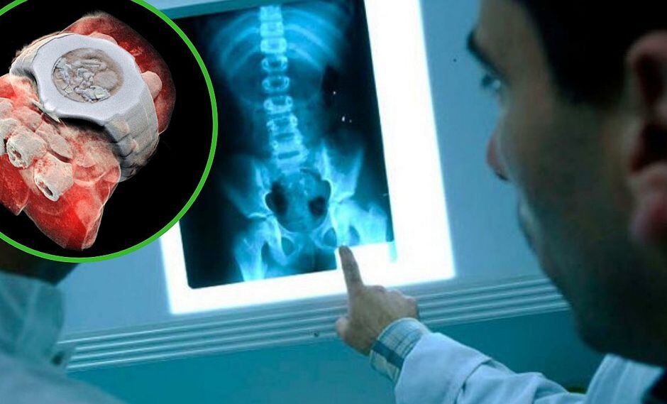 Adiós a los rayos X a blanco y negro: Crean radiografías a color