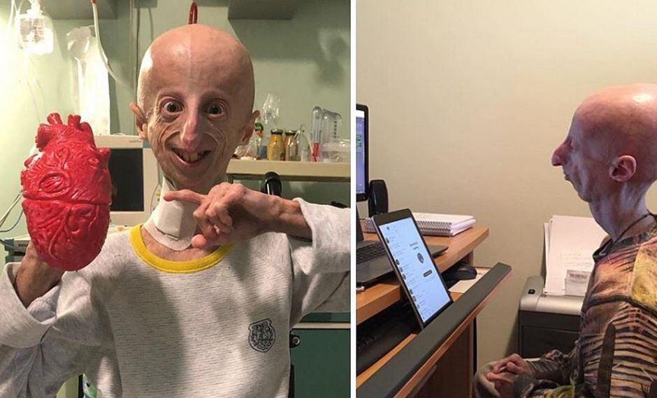 Joven científico con extraña enfermedad lucha para detener su propio envejecimiento (FOTOS)