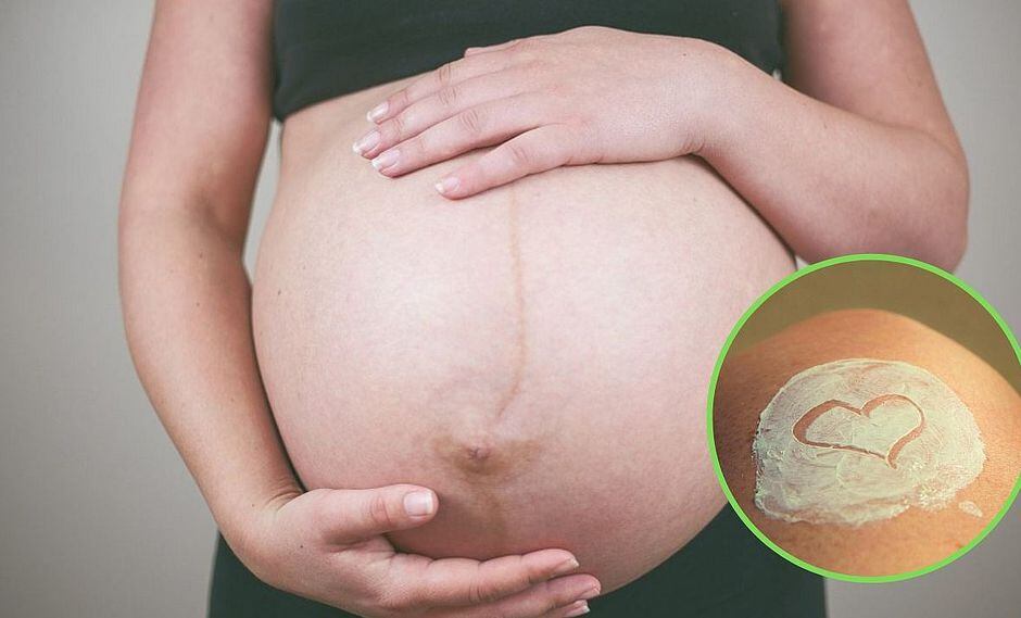 Conoce las cremas para evitar manchas en la cara durante el embarazo