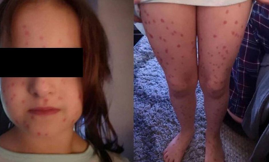 Niña se pinta puntos rojos para aparentar varicela y no ir al colegio, pero todo le sale mal