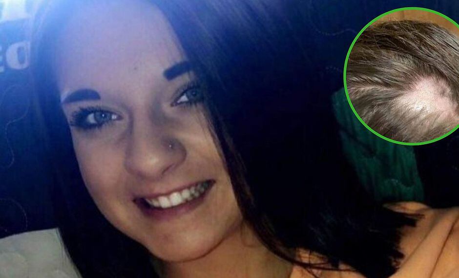 Joven compró acondicionador en un supermercado y terminó calva│FOTOS