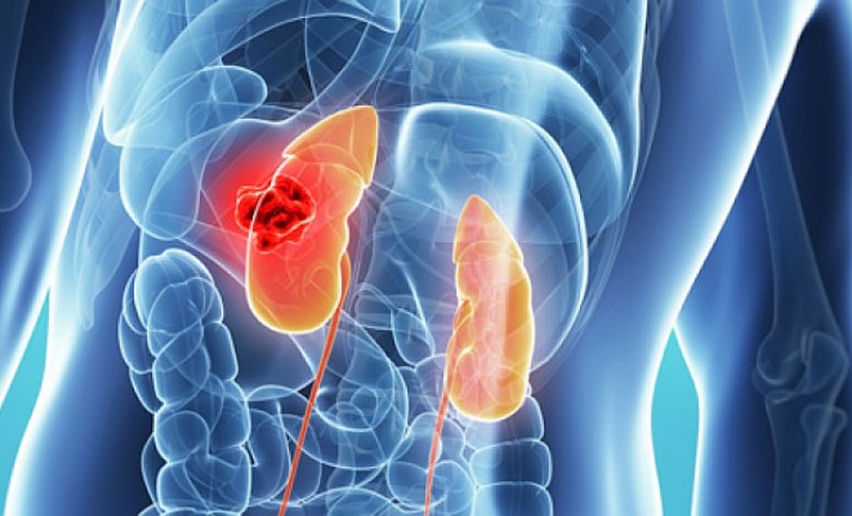 Cáncer Renal: Incidencias y síntomas
