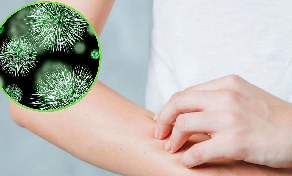 ¿Qué es la bacteria comecarne y cómo es posible un contagio?