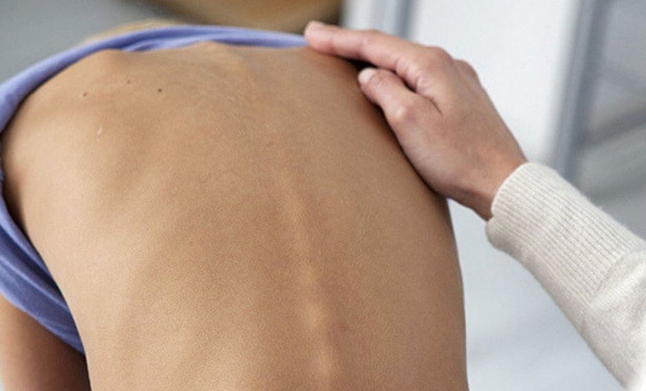 3 de cada 100 personas padece de escoliosis: aprende a detectarlo a tiempo