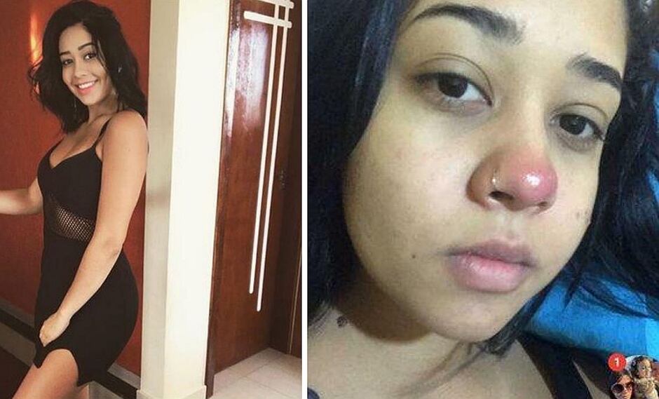 Mujer se pone piercing en la nariz y queda al borde de ser parapléjica