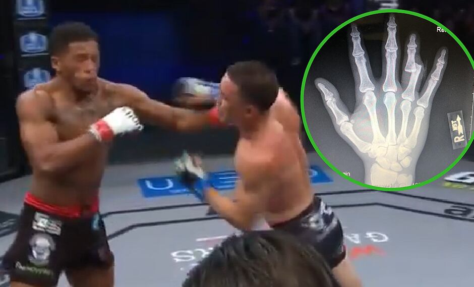Luchador de MMA pelea con el dedo roto y gana el combate (VIDEO)