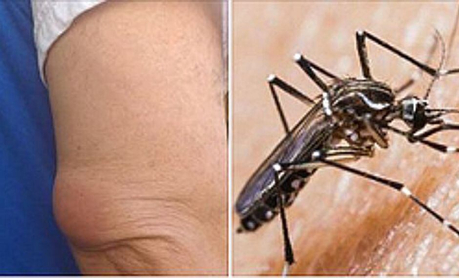 Callao: doctor fue a atender a paciente y sufrió picadura de mosquito aedes aegypti